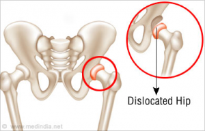 dislocated hip